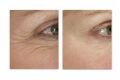 YONELLE Zwolińska Beauty Institute zaprasza na peeling peptydowy.